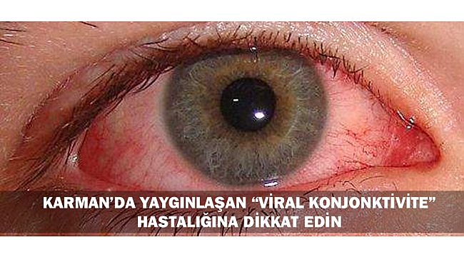 KARMAN’DA YAYGINLAŞAN “VİRAL KONJONKTİVİTE” HASTALIĞINA DİKKAT EDİN