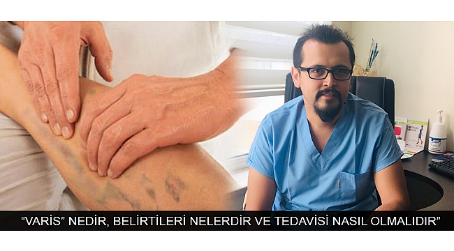 “VARİS” NEDİR, BELİRTİLERİ NELERDİR VE TEDAVİSİ NASIL OLMALIDIR”