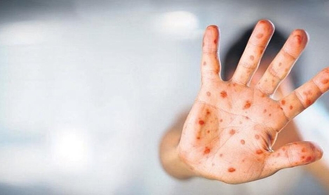 Bakan Koca açıkladı. Türkiye'de ilk Maymun Çiçeği Vakası Tespit Edildi