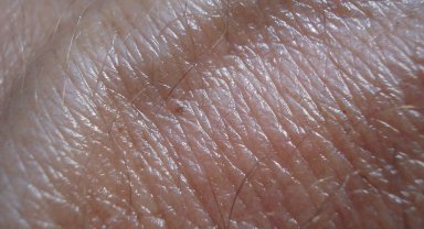 Yoğun ve kontrolsüz güneş ışınlarının deri kanserine sebep olduğu uyarısı yapıldı