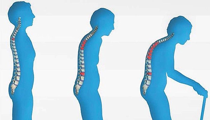Sırt bölgesindeki yaygın kemik ağrısı "osteoporoz" habercisi olabilir