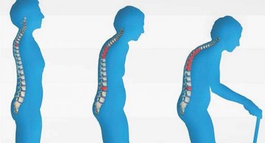 Sırt bölgesindeki yaygın kemik ağrısı "osteoporoz" habercisi olabilir