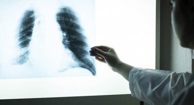 Türkiye'de erkekler, kadınlara göre 3,5 kat daha fazla akciğer kanserine yakalanıyor
