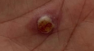 İl Sağlık Müdürü Yurdakul Şarbon Konusunda Vatandaşları Uyardı