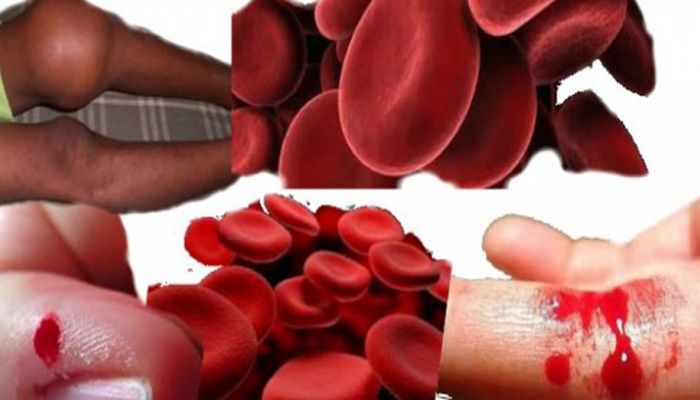 Dr. Altunsoy; “hemofili Genellikle Erkeklerde Görülen Bir Kan Hastalığıdır”