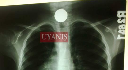 Minik Kız’ın Boğazında Bozuk Para Kaldı