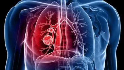 Karaman’da Verem Eğitimi ve Farkındalık Haftası